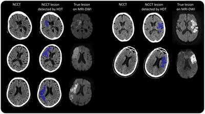 Novel artificial intelligence-based hypodensity detection tool improves clinician identification of hypodensity on non-contrast computed tomography in stroke patients